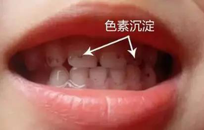 小孩牙齿表面一层黑能去掉吗,牙齿有块黑的怎么去掉