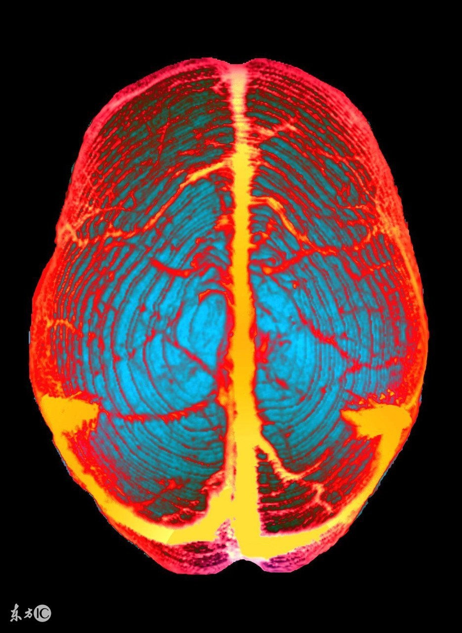 颅内静脉窦血栓形成怎么治疗,颅内静脉窦血栓怎么治疗