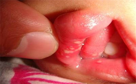 孩子口腔溃疡疼得厉害怎么办,口腔溃疡一吃东西牙疼