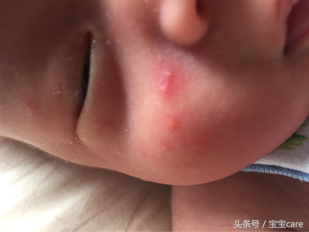 宝宝身上长密密麻麻小疙瘩怎么办,宝宝身上长小疙瘩不红