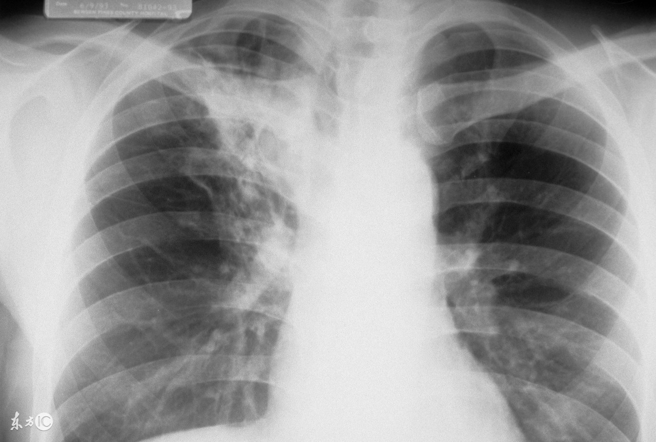 诊断出肺结核,怀疑自己得肺结核