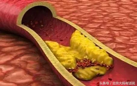 白发跟心脑血管疾病有关系吗,白发变黑发吃哪些维生素