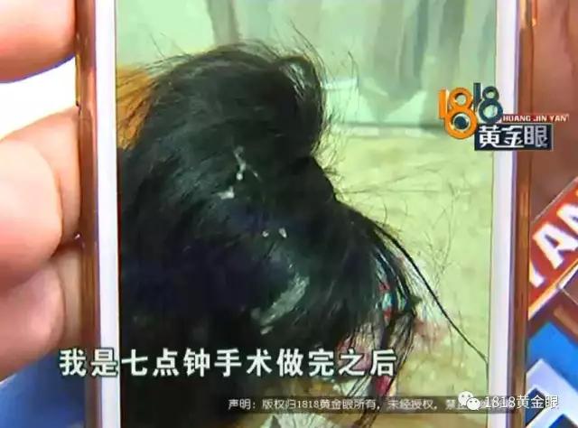 割完双眼皮，头发被胶水粘住！看监控，发现同行的闺蜜有可疑动作