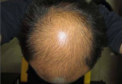 经常熬夜导致严重脱发怎么挽救,经常熬夜导致严重脱发怎么办