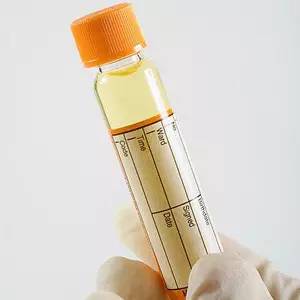 一招看懂尿常规,30秒教你看懂尿常规