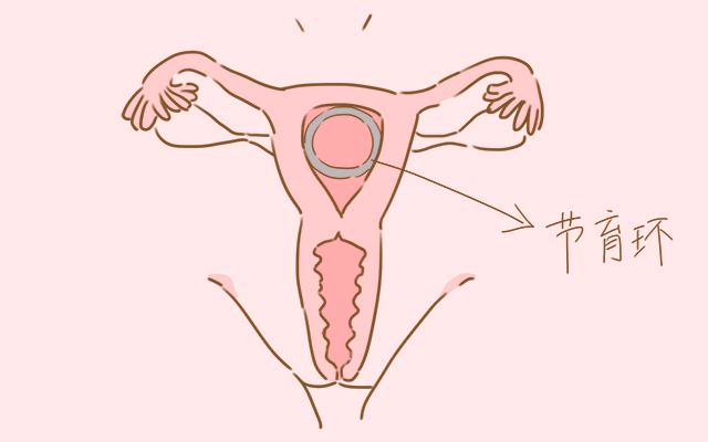取环时疼吗取环后要注意什么,取环疼不疼啊