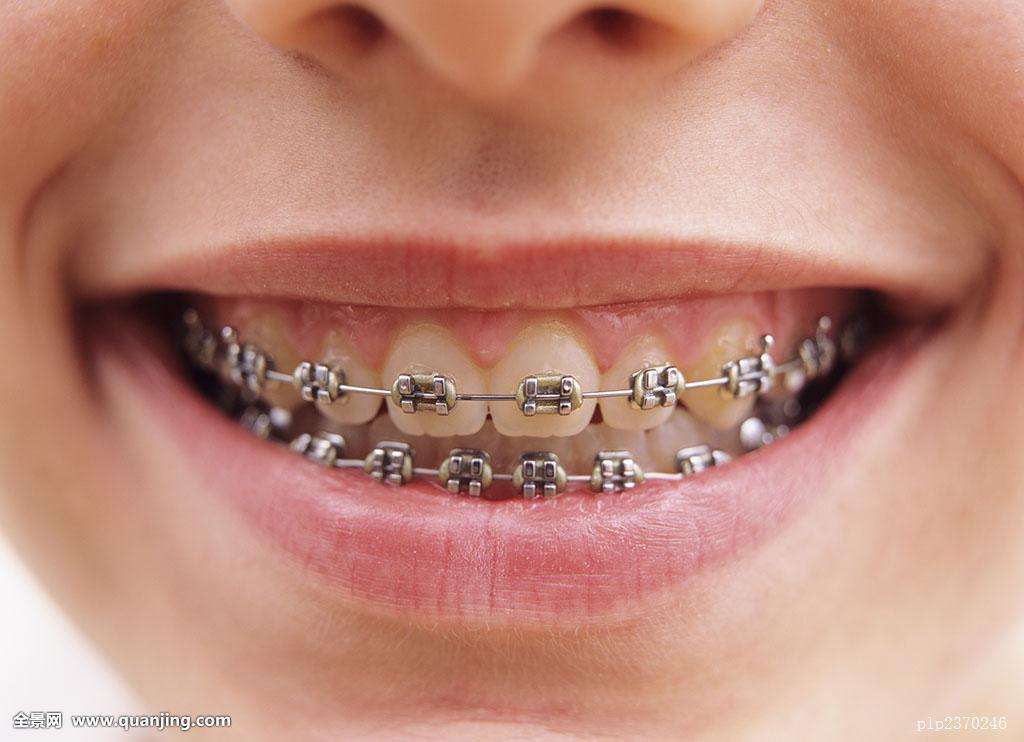 少了一颗牙齿戴牙套矫正全过程,不用牙套能不能把龅牙搞回去