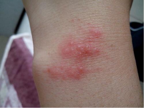 湿疹有什么草能治好,什么草治疗湿疹最有效