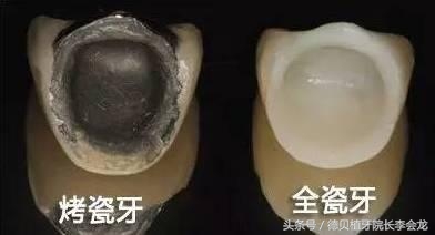 几百元一颗牙齿,几百一颗的牙贴面好吗