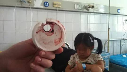 6岁宝宝喝水,不慎将舌头卡住瓶盖至血肿僵硬