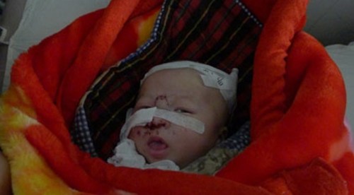 被老鼠咬伤后怎么办,被老鼠咬出血要不要打狂犬病疫苗