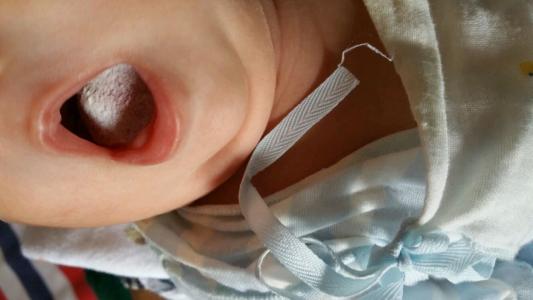 制霉菌素片治疗婴儿鹅口疮怎么用,婴儿鹅口疮的快速治疗方法