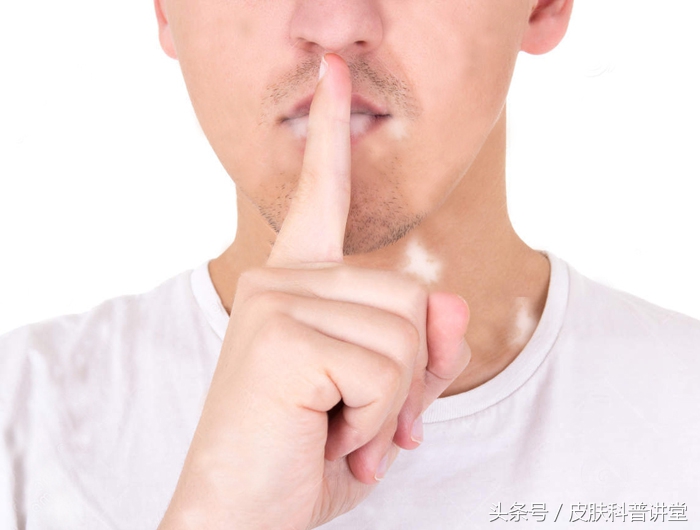 白癜风最新治疗方法录音,白癜风的治疗新进展