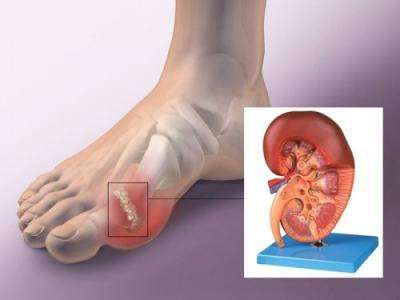 痛风快犯了怎么阻止,痛风治疗刻不容缓