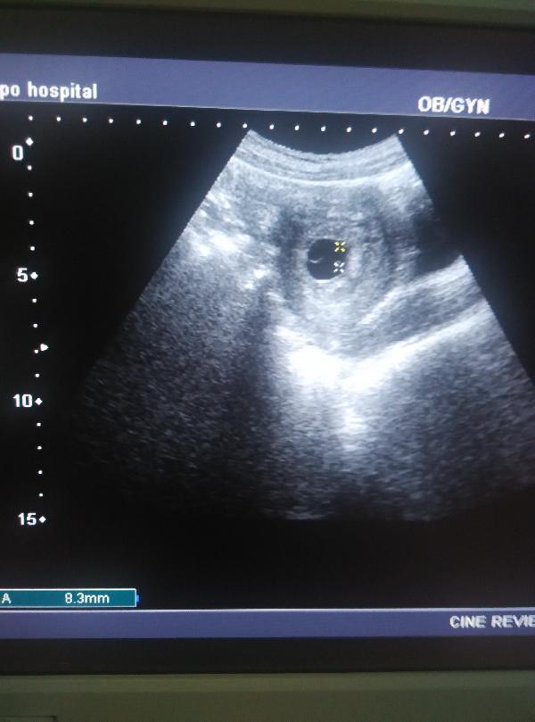 阴式超声检查会导致流产吗,刚怀孕做超声对宝宝有影响吗