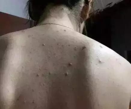 为什么会长了好多小米粒疙瘩,背后长了一粒小米粒