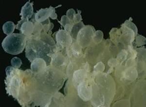 怀孕50天肚子里却没孩子,医生告知是葡萄胎?