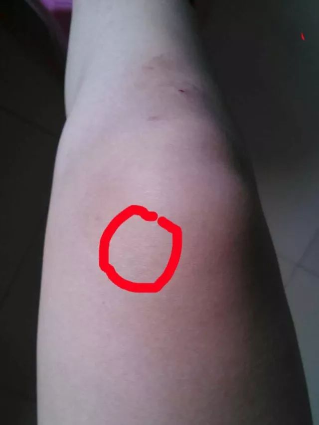 髌腱支持带在哪个位置,髌腱炎和髌腱末端病的区别