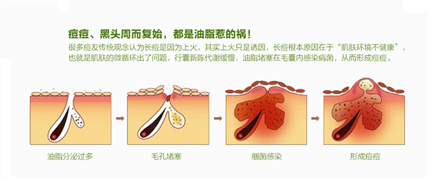 闭合性痘痘最佳治疗方法,闭合性痘痘里面有粉刺