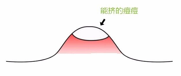 挤完痘痘后皮肤护理视频,挤完痘痘修复视频