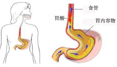 酒后贲门撕裂吐血,酒后胃吐血