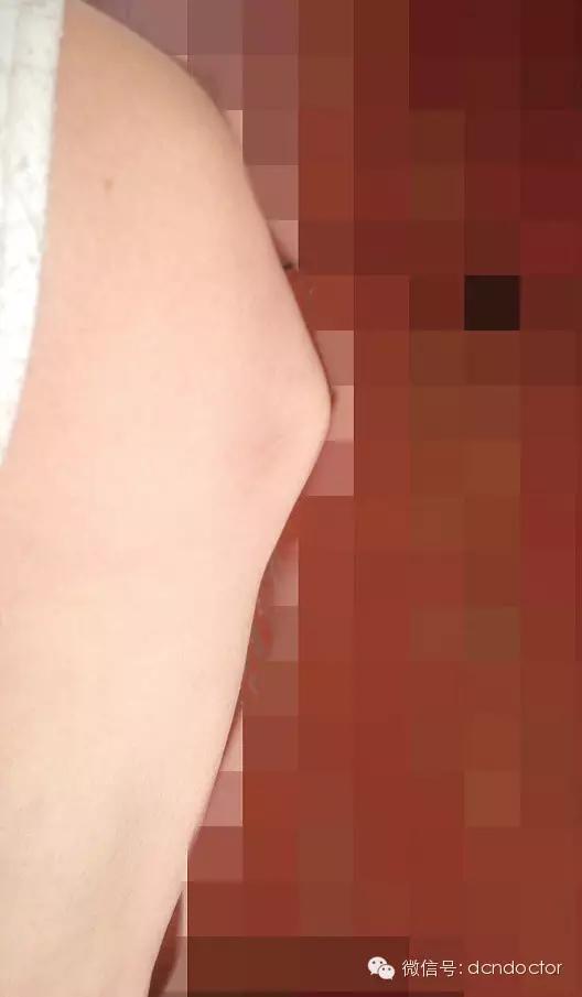 成年人胫骨结节软骨炎要怎么治疗,孩子胫骨结节软骨炎很疼怎么办