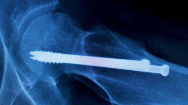 股骨颈骨折怎么才能恢复得快,股骨颈骨折一般多久可以下地负重