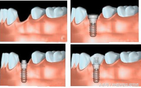 种植牙上颌窦提升术的并发症,瑞典种植牙astre术后并发症