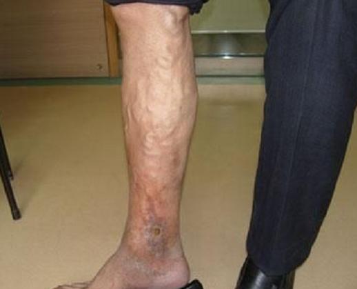 小腿浅静脉栓塞的症状及治疗方法,小腿深静脉栓塞的最佳治疗方法