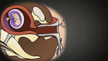 人流对生娃有什么影响,人流跟生孩子哪个危害更大