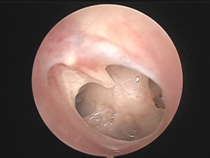 鼓膜挫伤听力下降,鼓膜外伤怎么处理