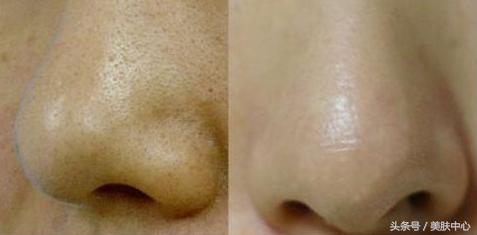 脸上毛孔老是堵塞用什么药膏,面部油脂过多毛孔堵塞怎么办