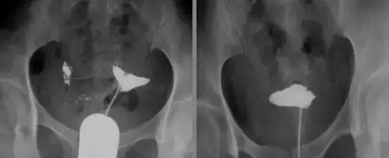 输卵管造影有多重要？这些你都知道吗？