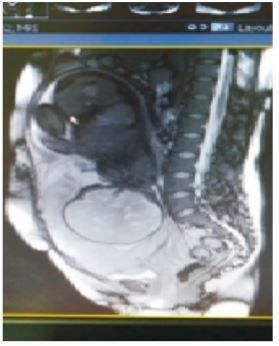 凶险性前置胎盘出血4次,边缘性前置胎盘大出血保胎成功率