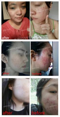 粉刺没有处理好变成硬疙瘩,痘痘粉刺消不掉