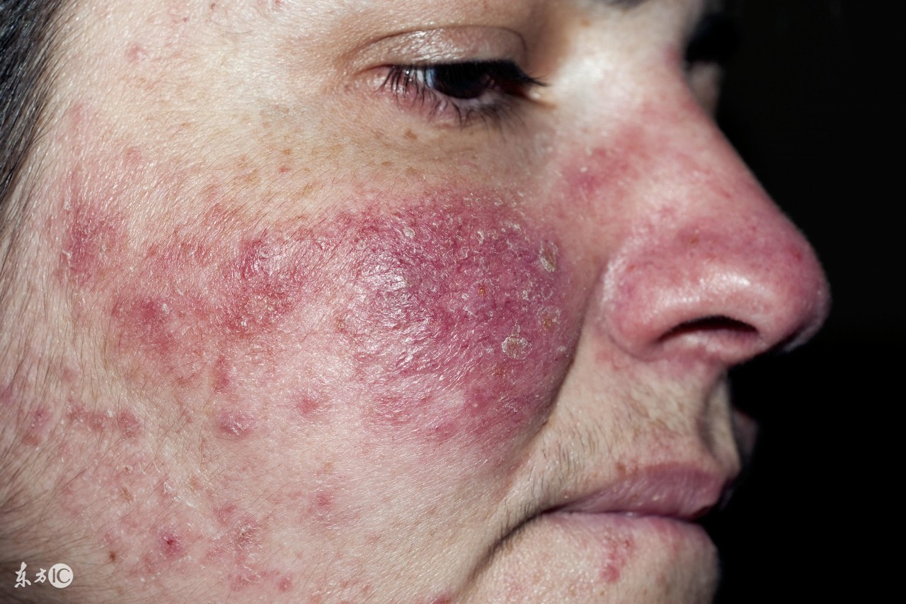 治疗激素脸真的像修仙一样!除了忌口,激素脸治疗还有哪些注意的