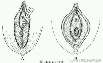 家有女儿的家长看过来,女宝外阴粘连长大了会影响吗