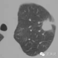 氩氦刀冷冻消融肿瘤,氩氦刀治疗肿瘤的风险