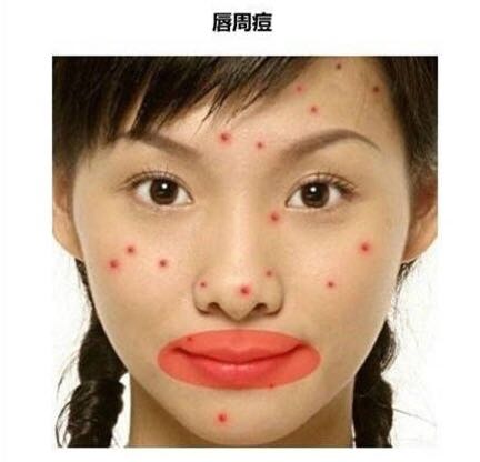 长痘真的影响颜值教你祛痘小妙招,祛痘小知识如何正确避免长痘