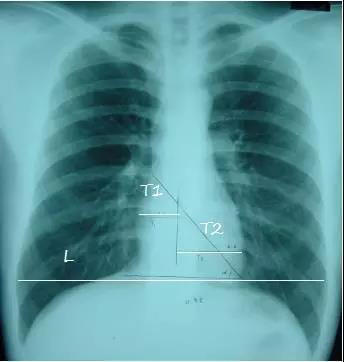 读完该文,让你学会如何看胸片