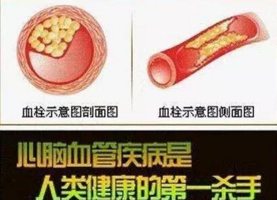 太极拳站桩治疗脑梗塞吗,站桩对心脑血管病有帮助吗