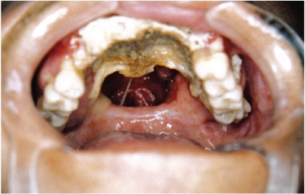 鼻子和嘴臭,鼻喉传出腐烂臭味