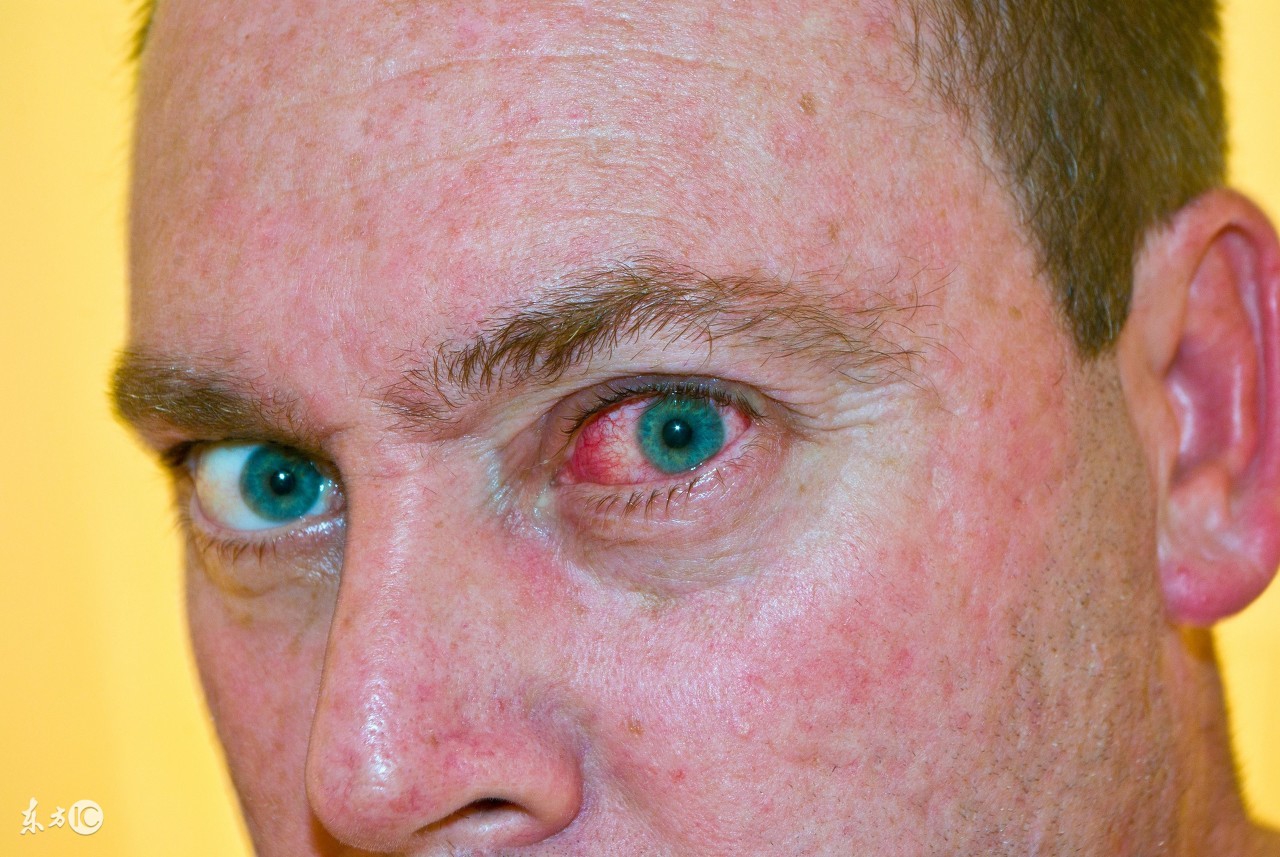 脸上发红有红血丝很严重怎么办,一激动就脸上长红疹