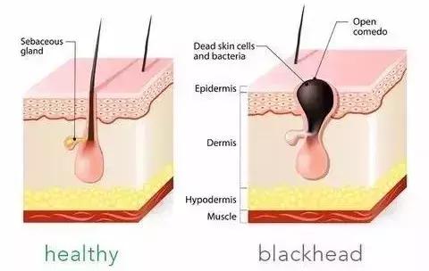 只需20块钱就能去黑头,平价去黑头神器
