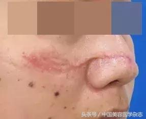 点阵激光治疗下颌瘢痕疙瘩有效么,二氧化碳激光治疗瘢痕增生原理
