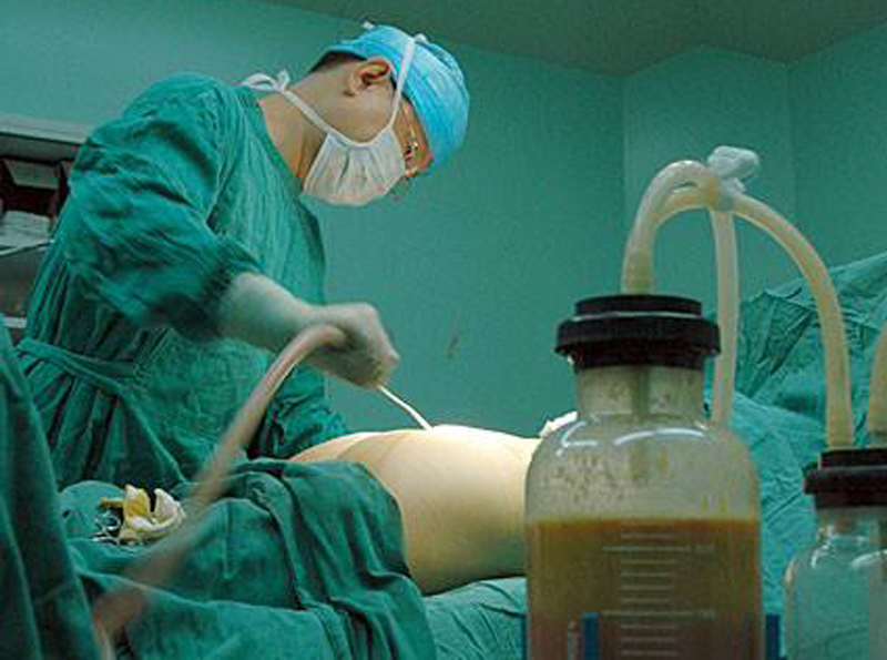 吸脂减肥大概费用是多少呢,吸脂减肥20斤该花费多少钱呢