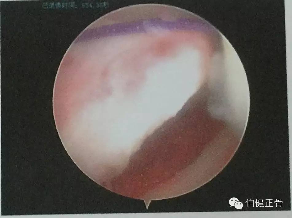 关节内外、经骨骺/不经骨骺单隧道纽扣技术治疗小儿前交叉韧带止点撕脱骨折经验介绍