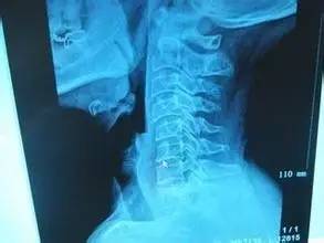 颈椎滑脱怎么治最佳办法,颈椎滑脱锻炼方法