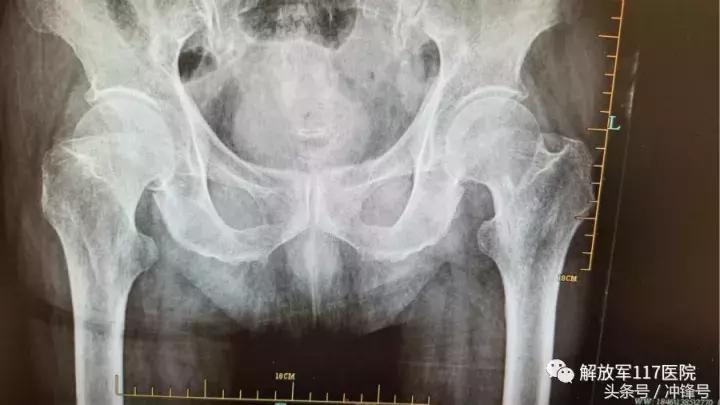 85岁老人关节置换术后存活,70岁老人做关节置换术