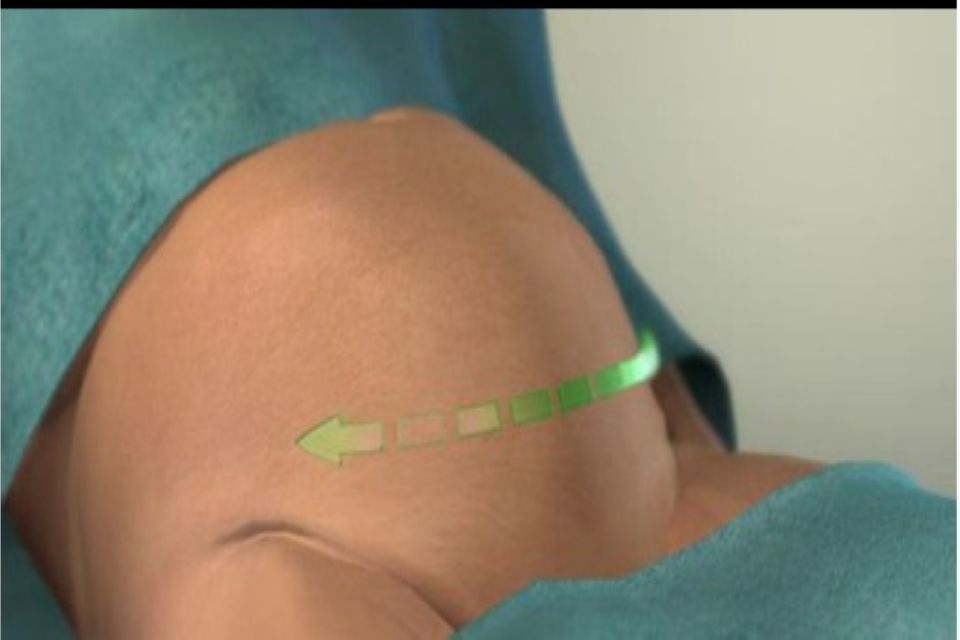 剖腹产会引起宫颈粘连吗,剖腹产的后遗症子宫粘连怎么办